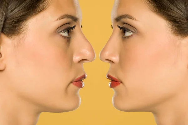 Beuatifull Young Woman Nose Surgery — Stock Photo, Image