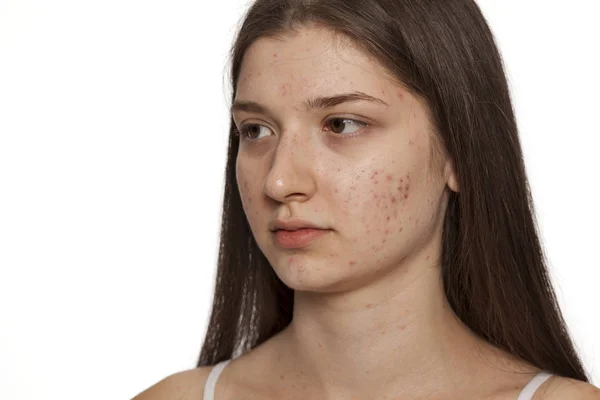 Adolescente Avec Peau Problématique Sur Fond Blanc — Photo