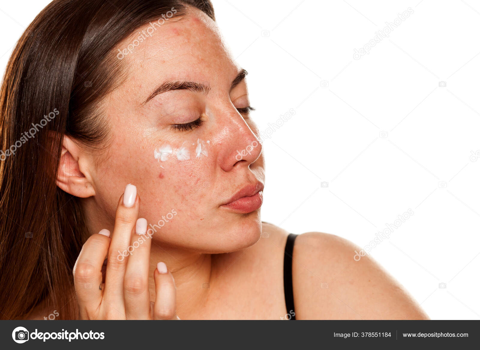 фотодерматит (фотодерматоз). мелкая красная сыпь на лице. на лицо белая жидкость. эритемато телеангиоэктазическая розацеа. эритематотелангиектатическая розацеа.