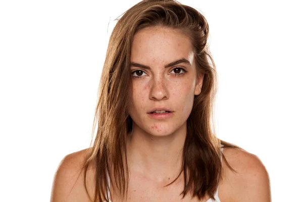 Portrét Mladé Krásné Ženy Frackles Problematickou Pletí Bílém Pozadí — Stock fotografie