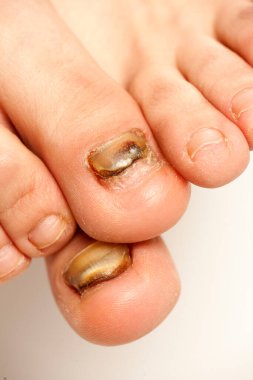 fungal infections of the nails of the feet of a young woman clipart
