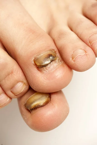 fungal infections of the nails of the feet of a young woman
