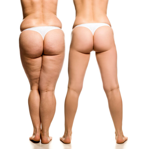 Buttocks, legs and waist of overweight woman before and after liposuction on white background