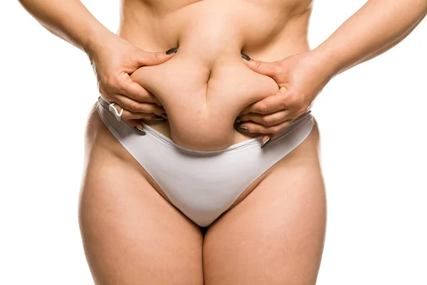 Μια Χοντρή Γυναίκα Τσιμπάει Την Κοιλιά Της Λευκό Φόντο — Φωτογραφία Αρχείου