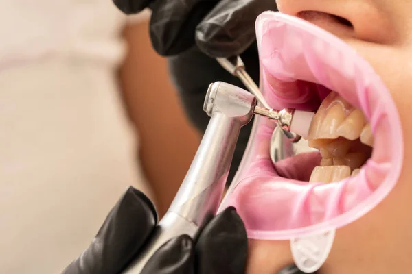 Macro Sesión Dentista Pule Los Dientes Paciente Con Taladro — Foto de Stock