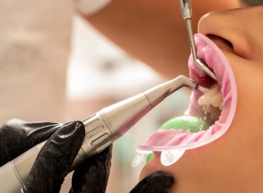 Closeup of teeth sandblasting, tartar cleaning and whitening clipart