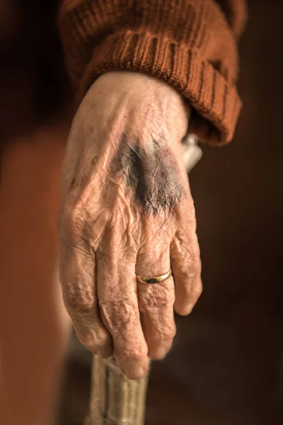Close Old Wrinkled Woman Hand Bruise Injection Arm — Stock Photo, Image