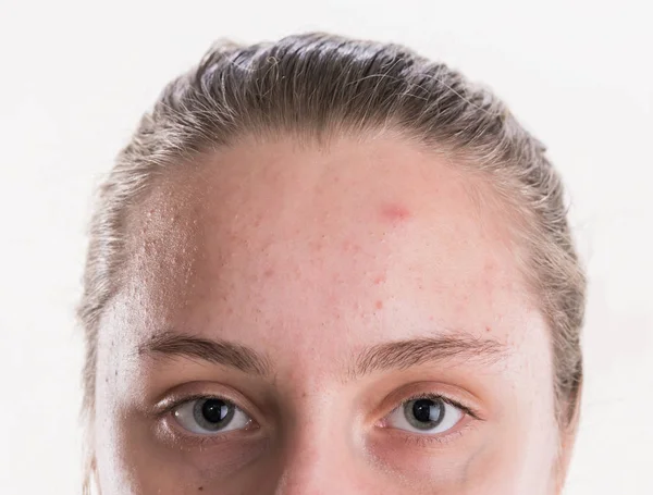 Acne Problem Concept Beautiful Teen Girl Problematic Skin Posing White — Stock Photo, Image
