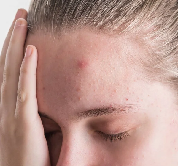 Acne Problem Concept Upset Teen Girl Problematic Skin Posing White — Stock Photo, Image