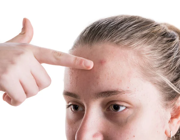 Acne Problem Concept Beautiful Teen Girl Problematic Skin Posing White — Stock Photo, Image