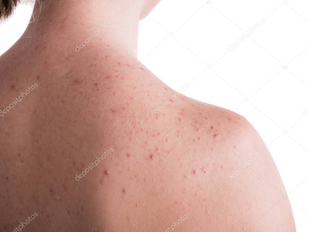 Acne problem concept. Teen girl with problematic skin on the back posing on a white background