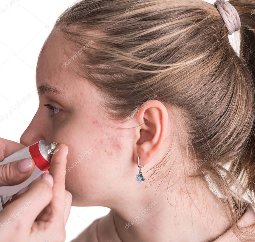 Skin care concept. Acne . Woman applying treatment cream on problematic skinof the teen girl 