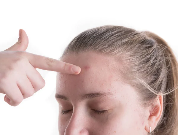 Acne Problem Concept Upset Teen Girl Problematic Skin Posing White — Stock Photo, Image