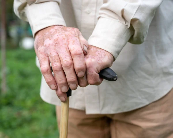 Närbild Manliga Händer Med Vitiligo Pigment Utomhus — Stockfoto