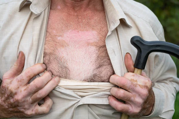 Close up of male hands and chest with vitiligo pigments outdoors