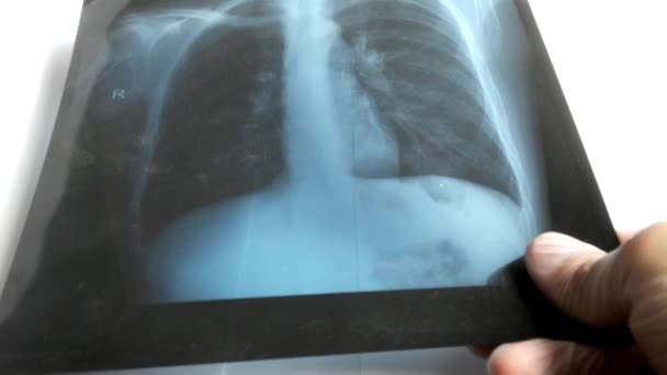 Der Arzt hält einen Schutzhandschuh am rechten Hand-Röntgenbild der Lungen. Nachweis einer Lungenentzündung durch Coronavirus, COVID-19. Arzt untersucht. — Stockvideo
