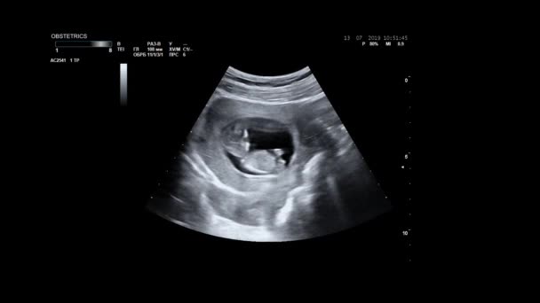 Ультрасонографія вагітної жінки. УЗД дитячого тіла та хребта. Крихітна дитина перетворюється на маминий живіт. 12 тижнів життя. Малюк у маминій утробі рухається під час сонографії . — стокове відео