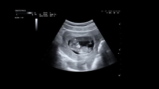 Ultrassonografia de mulher grávida. Ultra-som do corpo do bebê e coluna vertebral. O bebé está a entregar a barriga às mães. 12 semanas de vida. Bebê no útero das mães está se movendo durante a ultrassonografia . — Vídeo de Stock