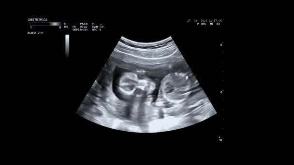 妊婦の超音波検査.赤ちゃんの体と脊椎の超音波。小さな赤ちゃんが腹を立てている。16週間の人生だ。母親の子宮の赤ちゃんはソノグラフィー中に動いています. — ストック動画