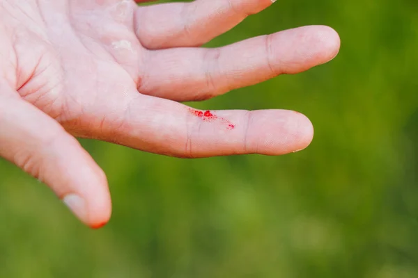 Sangue em um dedo em um contexto verde borrado de grama e árvores. Mão chamativa de um trabalhador. Close-up. calo na mão . — Fotografia de Stock