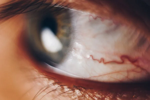 Macroojos con vasos sanguíneos rojos reventados. globo ocular cubierto de sangre de cerca. problemas de visión . — Foto de Stock