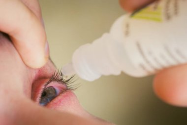 bir adam parlak kırmızı arterler ile açık insan gözü damlaları yakından görme geliştirmek için damla. tahriş ve göz küresi kızarıklık. gözbebekleri, iris, makro kirpikler. görme sorunları