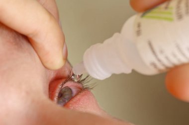 bir adam parlak kırmızı arterler ile açık insan gözü damlaları yakından görme geliştirmek için damla. tahriş ve göz küresi kızarıklık. gözbebekleri, iris, makro kirpikler. görme sorunları