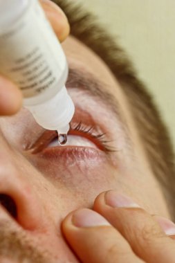 bir adam parlak kırmızı arterler ile açık insan gözü damlaları yakından görme geliştirmek için damla. tahriş ve göz küresi kızarıklık. gözbebekleri, iris, makro kirpikler. görme sorunları