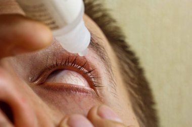 bir adam parlak kırmızı arterler ile açık insan gözü damlaları yakından görme geliştirmek için damla. tahriş ve göz küresi kızarıklık. gözbebekleri, iris, makro kirpikler. görme sorunları