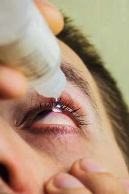 bir adam parlak kırmızı arterler ile açık insan gözü damlaları yakından görme geliştirmek için damla. tahriş ve göz küresi kızarıklık. gözbebekleri, iris, makro kirpikler. görme sorunları