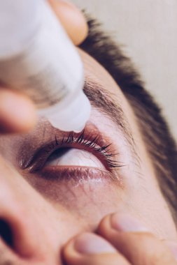 bir adam parlak kırmızı arterler ile açık insan gözü damlaları yakından görme geliştirmek için damla. tahriş ve göz küresi kızarıklık. gözbebekleri, iris, makro kirpikler. görme sorunları