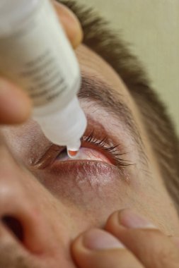 bir adam parlak kırmızı arterler ile açık insan gözü damlaları yakından görme geliştirmek için damla. tahriş ve göz küresi kızarıklık. gözbebekleri, iris, makro kirpikler. görme sorunları