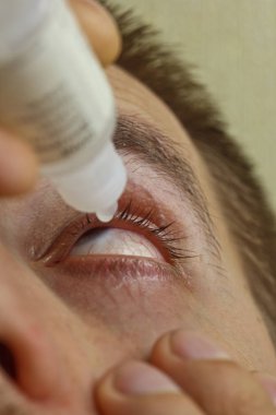 bir adam parlak kırmızı arterler ile açık insan gözü damlaları yakından görme geliştirmek için damla. tahriş ve göz küresi kızarıklık. gözbebekleri, iris, makro kirpikler. görme sorunları