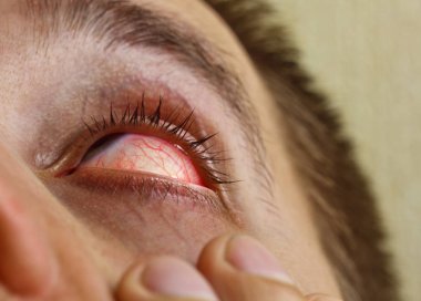 bir adam parlak kırmızı arterler ile açık insan gözü damlaları yakından görme geliştirmek için damla. tahriş ve göz küresi kızarıklık. gözbebekleri, iris, makro kirpikler. görme sorunları