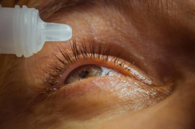 bir adam parlak kırmızı arterler ile açık insan gözü damlaları yakından görme geliştirmek için damla. tahriş ve göz küresi kızarıklık. gözbebekleri, iris, makro kirpikler. görme sorunları