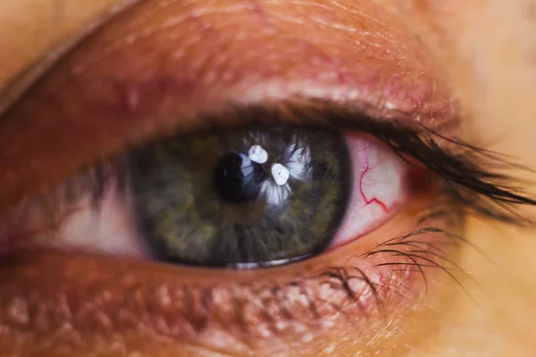 Olho humano aberto com artérias vermelhas brilhantes perto. irritação e vermelhidão do globo ocular. pupilas, íris, pestanas em macro. problemas de visão — Fotografia de Stock