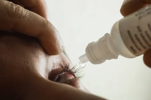 Um homem pinga olho humano aberto com gotas de artérias vermelhas brilhantes para melhorar a visão de perto. irritação e vermelhidão do globo ocular. pupilas, íris, pestanas em macro. problemas de visão — Fotografia de Stock