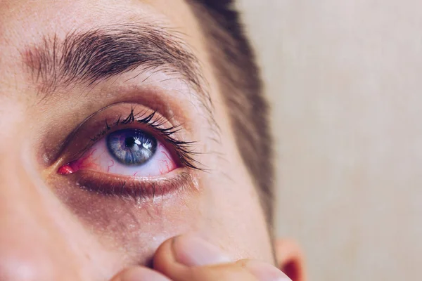 Um homem pinga olho humano aberto com gotas de artérias vermelhas brilhantes para melhorar a visão de perto. irritação e vermelhidão do globo ocular. pupilas, íris, pestanas em macro. problemas de visão — Fotografia de Stock