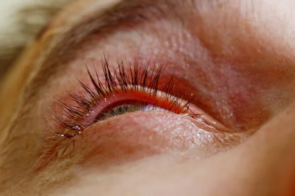 Een man druipt open menselijk oog met heldere rode slagaders druppels om het gezichtsvermogen close-up te verbeteren. irritatie en roodheid van de oogbol. leerlingen, Iris, wimpers in macro. problemen met het gezichtsvermogen — Stockfoto