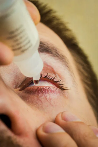 Um homem pinga olho humano aberto com gotas de artérias vermelhas brilhantes para melhorar a visão de perto. irritação e vermelhidão do globo ocular. pupilas, íris, pestanas em macro. problemas de visão — Fotografia de Stock