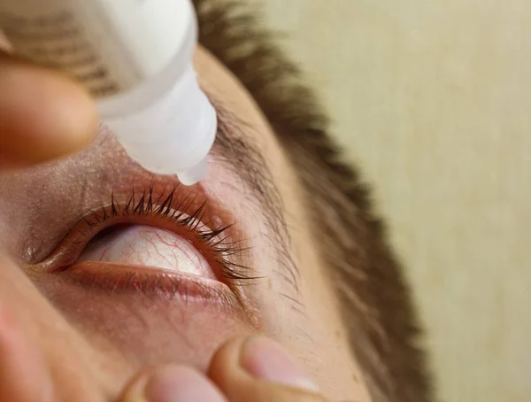 Um homem pinga olho humano aberto com gotas de artérias vermelhas brilhantes para melhorar a visão de perto. irritação e vermelhidão do globo ocular. pupilas, íris, pestanas em macro. problemas de visão — Fotografia de Stock