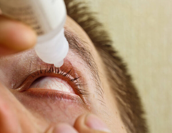 a man drips open human eye with bright red arteries drops to improve vision close up. irritation and redness of the eyeball. pupils, iris, eyelashes in macro. vision problems