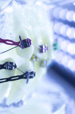 Ortodonti diş hekimleri öğretim modeli diş diş plastik ve metal köşeli parantez her diş düzleştirmek için aligners.