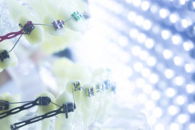 Ortodonti diş hekimleri öğretim modeli diş diş plastik ve metal köşeli parantez her diş düzleştirmek için aligners.