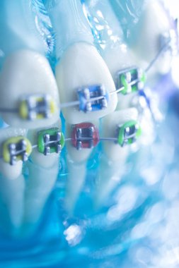 Ortodontik diş hekimliği tedavileri diş düzeltmek için aligners ayraç diş diş tutucular metal.
