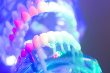 Dişeti, diş minesini, plak, kökleri ve metal implantlar ile diş diş ortodontik diş hekimliği teachng modeli.