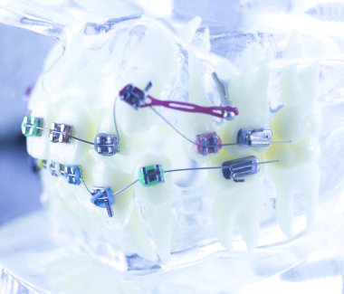 Ortodonti diş hekimleri öğretim modeli diş diş plastik ve metal köşeli parantez her diş düzleştirmek için aligners.