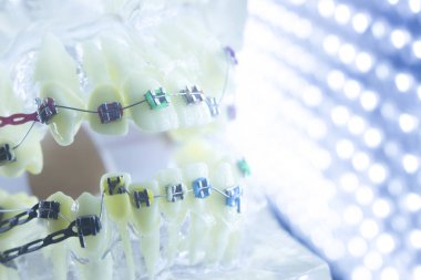 Ortodonti diş hekimleri öğretim modeli diş diş plastik ve metal köşeli parantez her diş düzleştirmek için aligners.