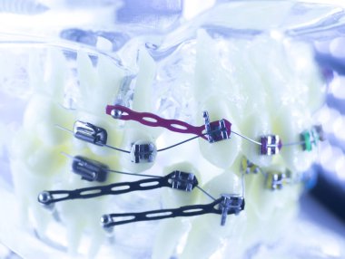 Ortodonti diş hekimleri öğretim modeli diş diş plastik ve metal köşeli parantez her diş düzleştirmek için aligners.