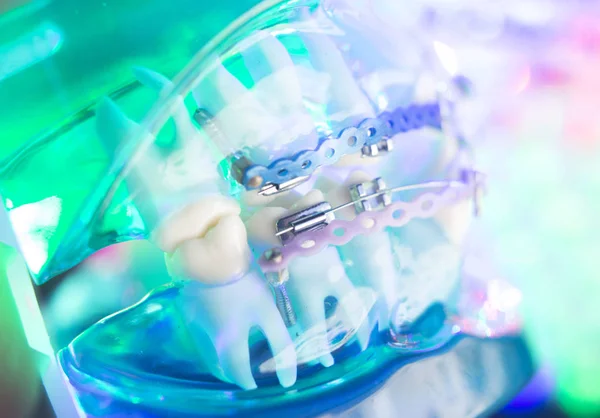 Tandheelkundige Tanden Vazallen Metal Aligners Haakjes Het Rechtzetten Van Tanden — Stockfoto